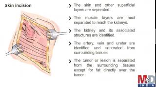 Partial nephrectomy [upl. by Kaenel769]