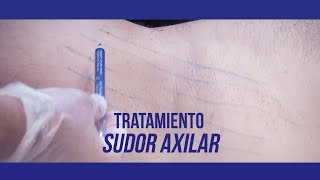 Tratamiento de sudor axilar Resumen [upl. by Guendolen]