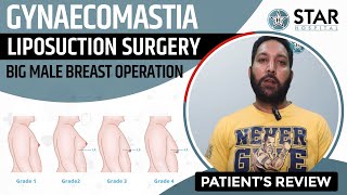 Gynecomastia Surgery In Kapurthala  Gynecomastia Treatment Male Boobs Surgery in Kapurthala [upl. by Dorwin]