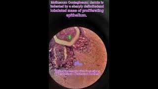 Molluscum contagiosumhistologyskininfectionspathologymedical [upl. by Henrietta]