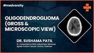Oligodendroglioma Gross amp Microscopic View  MedvarsityOnlineLtd [upl. by Gnoht]