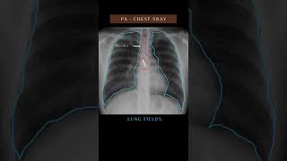 Chest Xray  PA view anatomy trendingshorts medical viralvideo reels shorts doctor [upl. by Debbi]