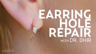 Earring Hole Repair for Laura  PLASTIC with Dr Dhir [upl. by Lladnyk548]