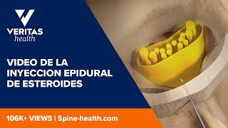 Video de la inyeccion epidural de esteroides [upl. by Hsak255]