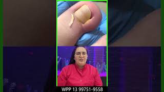 Luana Caldin podologa podologia unhas pedicure manicures encravada encravadas unha [upl. by Adiraf]