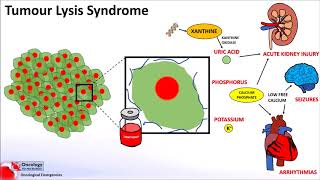 Tumour Lysis Syndrome [upl. by Hartman843]