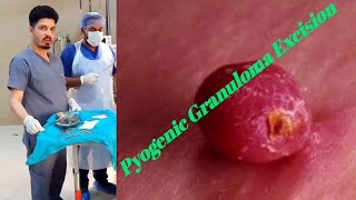 pyogenic granuloma treatment Pyostomatitis VegetansBacterial Infection Of The Oral Cavity [upl. by Nilek]