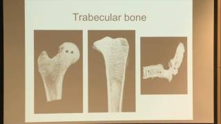 11 Trabecular Bone and Osteoporosis [upl. by Akcirred616]