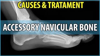 What is Accessory Navicular Bone Causes Symptoms and Treatments [upl. by Moriah]