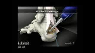 AchillessehnenEntzündung Neue Operationsmethode ORTHOPARC Klinik [upl. by Christoper]