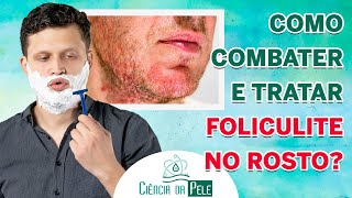 Como Tratar Foliculite no Rosto  MELHOR TRATAMENTO [upl. by Amalee]