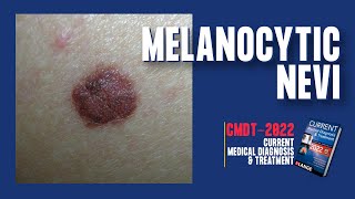 Melanocytic Nevi Normal Moles  PIGMENTED LESIONS  CMDT 2022 [upl. by De Witt]