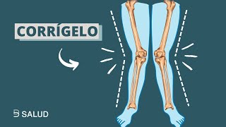 7 EJERCICIOS para ✅ CORREGIR LAS RODILLAS EN VALGO [upl. by John]