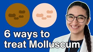 How to treat molluscum contagiosum with Pharmacist Virginia [upl. by Anigue]