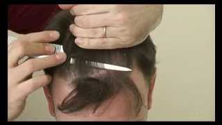 5889 FUT Hattingen Hair Transplantation Switzerland [upl. by Elehcim]