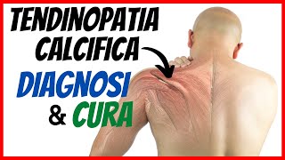 🔴 TENDINOPATIA CALCIFICA di SPALLA  Come si diagnostica e si cura [upl. by Nesnej865]