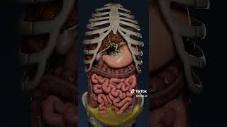 Ascites secondary to liver disease [upl. by Oca862]