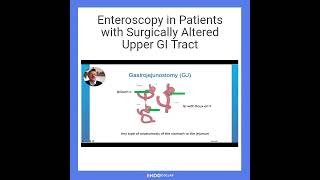 Enteroscopy in Patients with Surgically Altered Upper GI Tract [upl. by Abehsat]