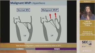 Diagnóstico y manejo de la insuficiencia mitral en 2018 [upl. by Spragens717]
