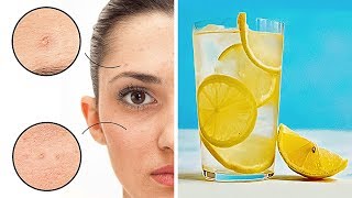 Drinking Lemon Water Daily Helped Me Clear My Skin Off Pimples [upl. by Analise179]