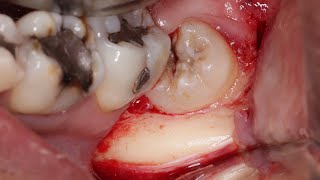 Extração de terceiros molares inferiores técnica cirúrgica [upl. by Nnahaid]