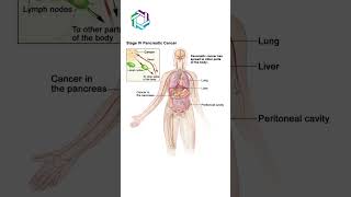 The Three Routes of Pancreatic Cancer Spread  Blood Lymph and Tissue  Dr Vivek Sukumar [upl. by Hanahs838]