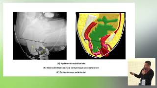 10 Troubles de la statique pelvienne  Radiologie conventionnelle ou IRM [upl. by Emmery522]