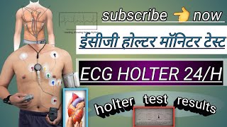 ecg holter monitor test  holter test results  holter monitor 24 hoursheart holter testviral [upl. by Stromberg]