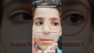 Duane Retraction Syndrome type 1 strabismus eyes ophthalmology [upl. by Acimot608]