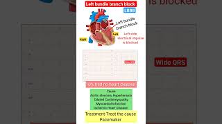 LBBB  Left bundle branch block ECG heart short video [upl. by Swift495]