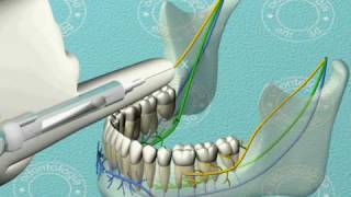 Dentista 3d Anestesia troncular www keepvid com [upl. by Eatnwahs]