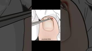 Ingrown Toenail 내성발톱 [upl. by Aidnis]