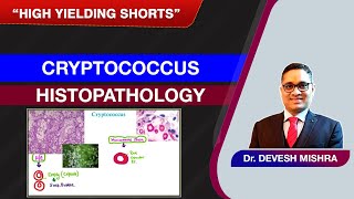 High Yielding Shorts26 HYS26  Cryptococcus histopathology by Dr Devesh Mishra [upl. by Furmark]