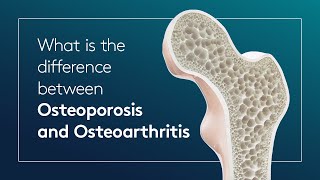 What is the difference between Osteoporosis and Osteoarthritis [upl. by Niraj]