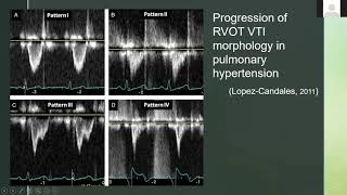 Evaluating RVOT Right Ventricular Outflow Tract With Ultrasound and Doppler [upl. by Broddy]