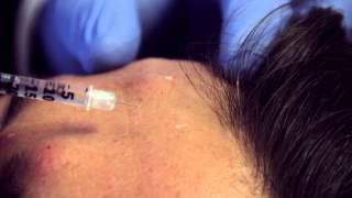 Dr Raj CCC demonstrates Anti Wrinkle treatment using BOTOX® [upl. by Aun]