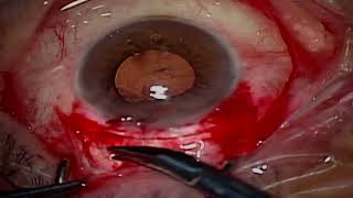 SICS  SMALL INCISION CATARACT SURGERY [upl. by Everard]