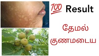 தேமல் சரியாக இது ஒன்னு போதும்  THEMAL Kunamaga  REMOVE WHITE PATCHES IN 5 DAYS [upl. by Letsirk]