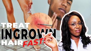 How to Remove Ingrown Hairs and Razor Bumps  This ACTUALLY works [upl. by Nelehyram551]