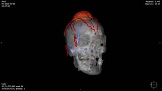 Parasagittal tumor with sagittal sinus invasion [upl. by Bushweller871]