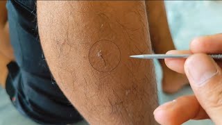 PLUCK INGROWN LEGS HAIRS for Mr kietngheokho Asmr [upl. by Imaon]