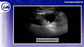 Iliopsoas Bursa Visualization on MSK Ultrasound [upl. by Silliw]