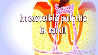 Irreversible pulpitis in tamilpulpitisflowerpot1564 [upl. by Secunda]