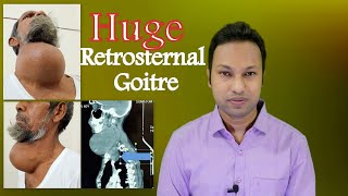 Huge Thyroid Enlargement Retrosternal or Substernal Goitre । Risk of Tracheomalacia amp Management [upl. by Enilemme35]