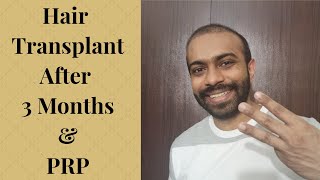 Hair Transplant after 3 months and PRP [upl. by Allveta]