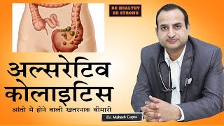 Ulcerative Colitis  अल्सरेटिव कोलाइटिसआंतो की गंभीर बीमारी  Dr Mahesh Gupta [upl. by Victoria611]