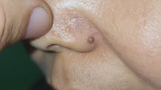 Scarless Co2 Laser Mole Removal [upl. by Nwahsek962]