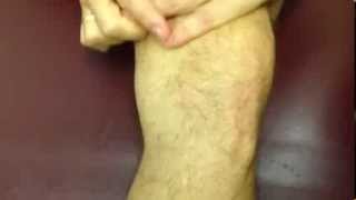 bulge sign for knee effusion [upl. by Assyle]