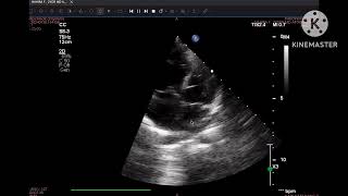 Sinus Venosus ASD of IVC type ￼ [upl. by Ttezzil322]