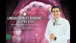 Lingual braces bonding step by step indirect bonding by transfer tray by Dr Amr Asker invisible [upl. by Arodal312]